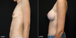 Chirurgie augmentation mammaire prothèse 01 - avant/après - profil